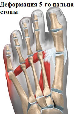 деформация пятого пальца стопы