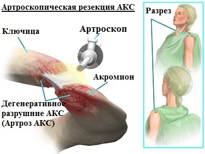 Артроскопическая резекция АКС