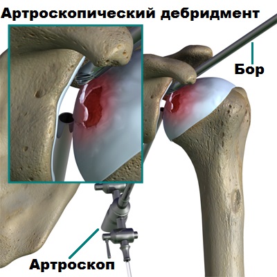 Артроскопический дебирмент