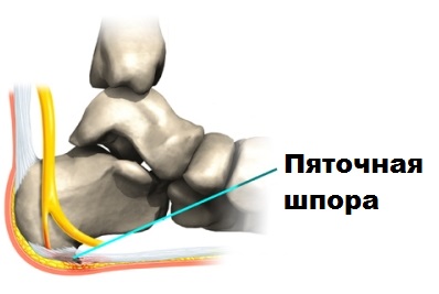 пяточная шпора