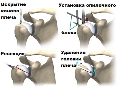 Артроскопия плечевого сустава. Подвывих протеза плечевого сустава. Реверсивное эндопротезирование плечевого сустава. Имплант плечевого сустава. Артропластика плечевого сустава ход операции.