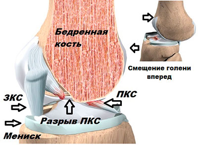 Передняя крестообразная связка фото