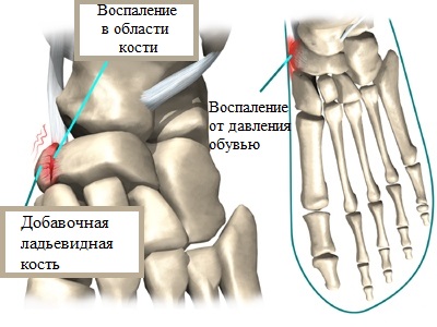 добавочная латьевидная кость стопы