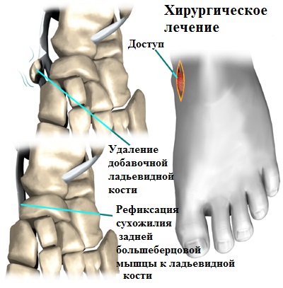 хирургическое лечение