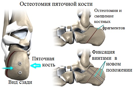 остеотомия пяточной кости