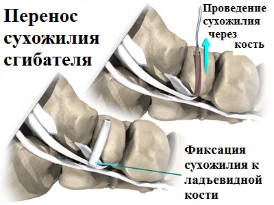 перенос сухожилия сгибателя 