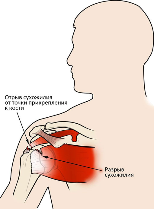 отрыв сухожилия от кости