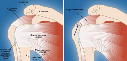 полнослойный разрыв сухожилия надостной мышцы