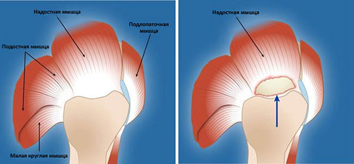 ротаторная манжета плеча анатомия