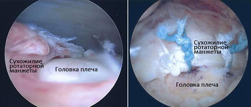 Сухожилие ротаторной манжеты