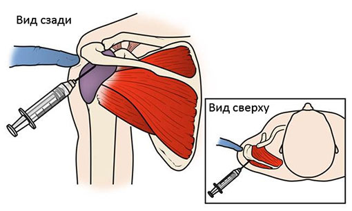 купирование болевого синдрома