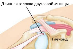 Схема отрыва длинной головки двуглавой мышцы плеча