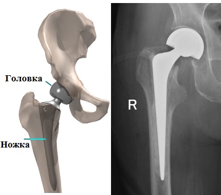 Эндопротез бедра фото