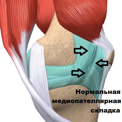 НОРМАЛЬНАЯ МЕДИОПАТЕЛЛЯРНАЯ СКЛАДКА