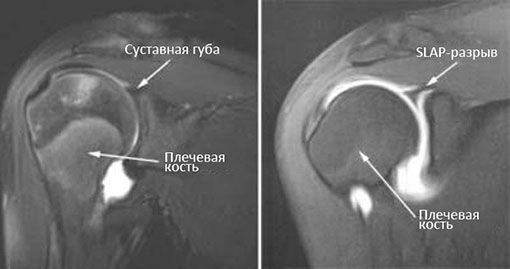 МР-томограмма плечевого сустава