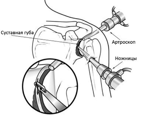 операци на плече