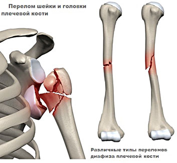 Перелом шейки и головки