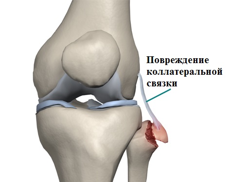 повреждение наружной коллатеральной связки